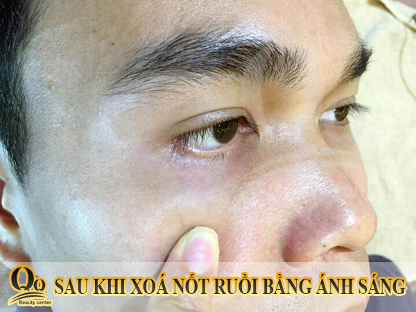 gel-tay-not-ruoi-cua-nga-co-hieu-qua-khong.JPG