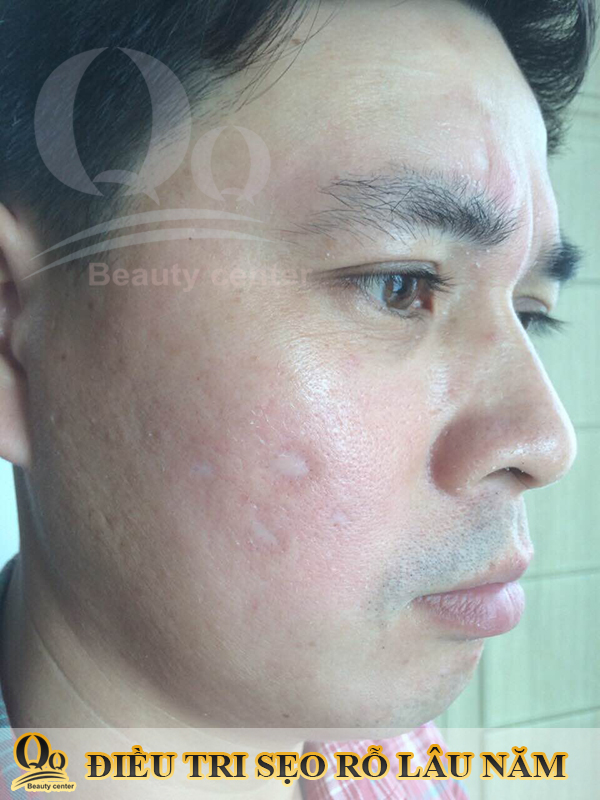 Thuốc trị sẹo lõm hiruscar có tốt không ?
