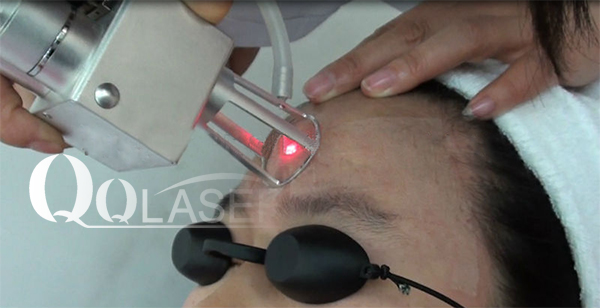 laser-2-acupules.jpg