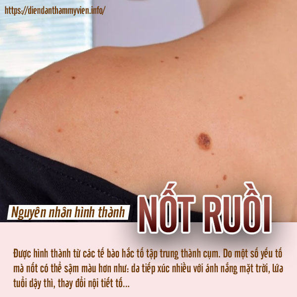 nguyen-nhan-hinh-thanh-not-ruoi.jpg