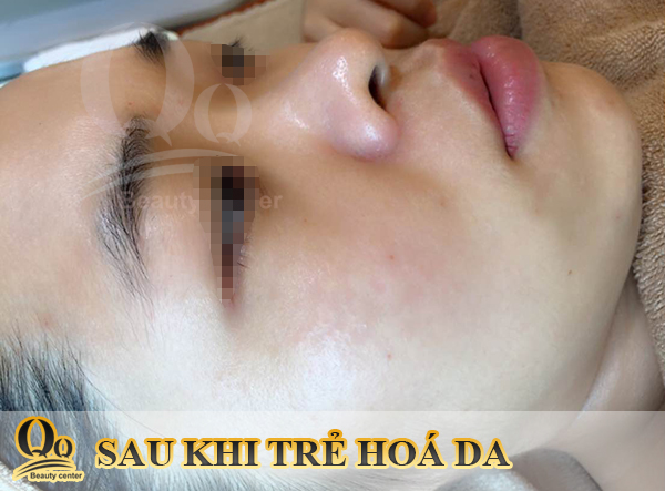 sau-khi-su-dung-kem-tri-nam.jpg